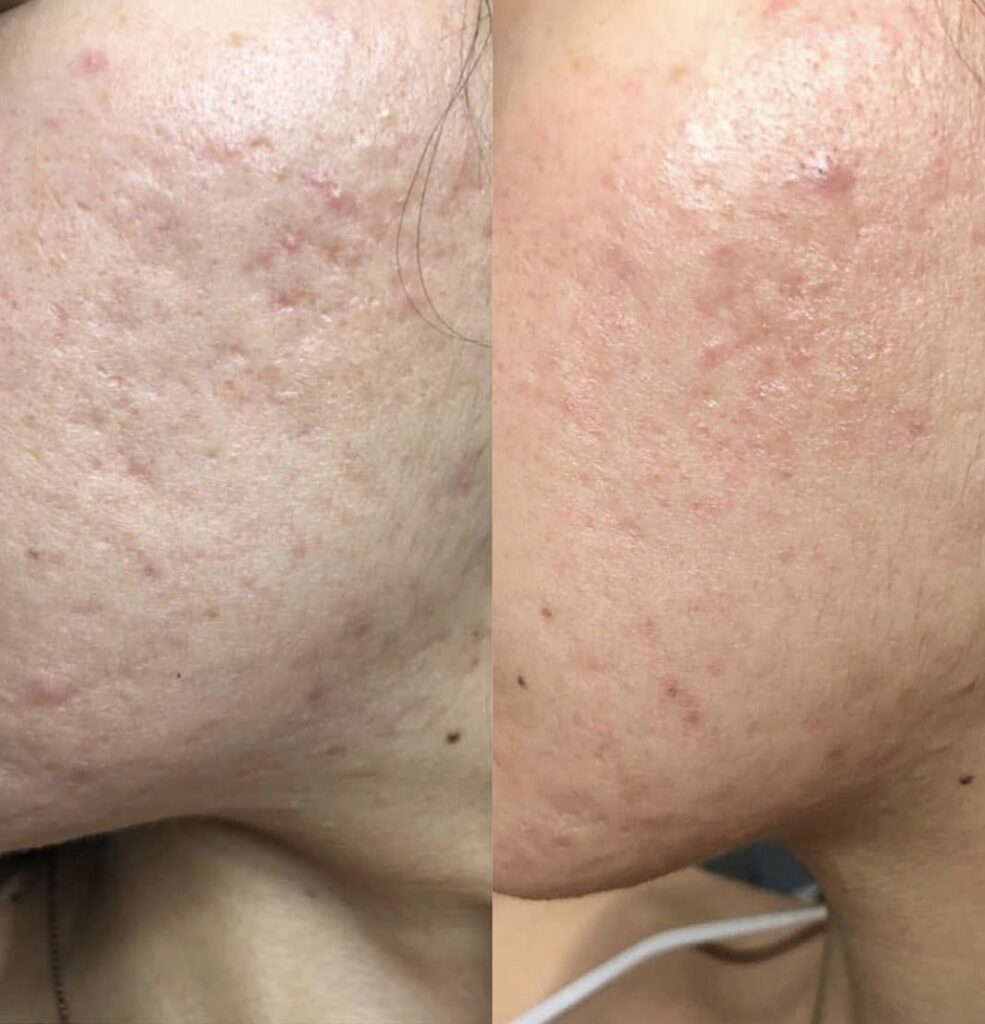 Microneedling with PRP Before and After Photo by Refresh Palm Beach Medical Aesthetics in Jupiter Florida