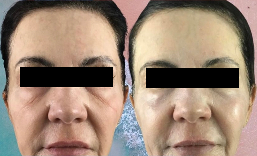 Sofwave Before and After Photo by Refresh Palm Beach Medical Aesthetics in Jupiter Florida