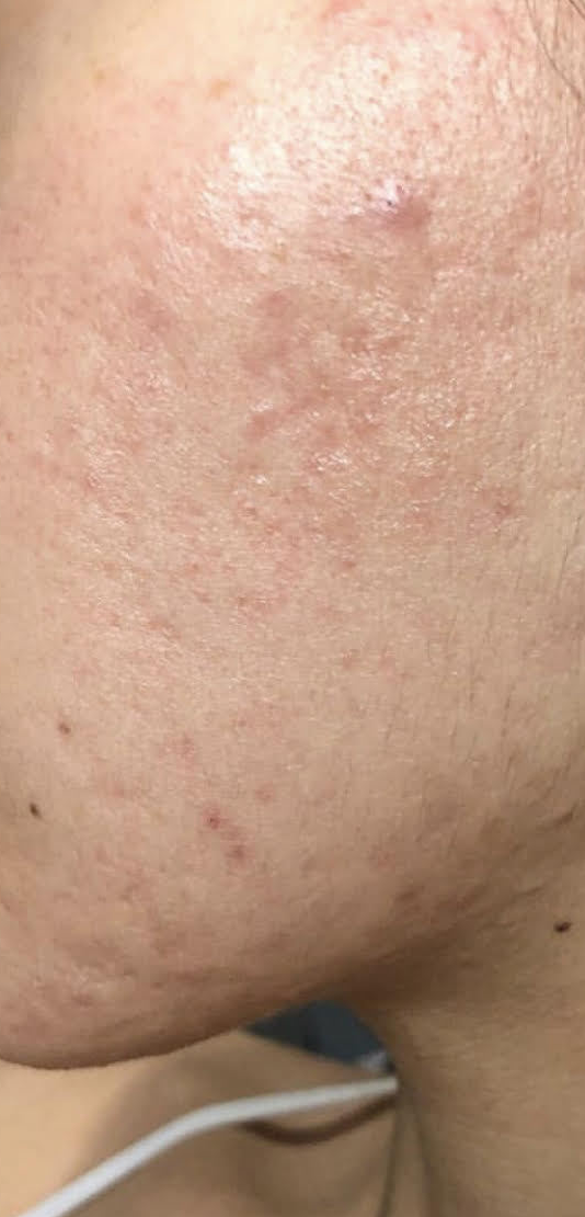 Microneedling with PRP Before and After Photo by Refresh Palm Beach Medical Aesthetics in Jupiter Florida
