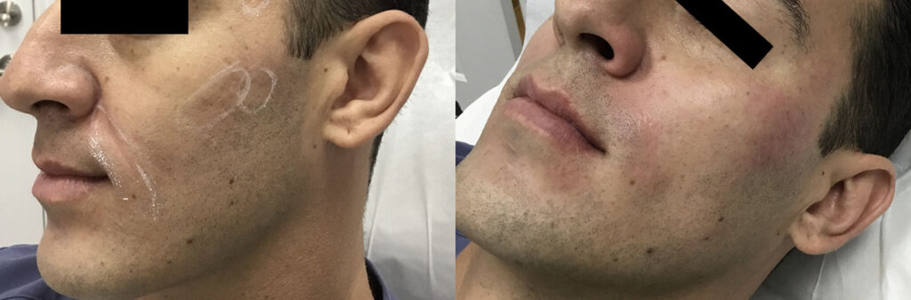 PRP injections Before and After Photo by Refresh Palm Beach Medical Aesthetics in Jupiter Florida