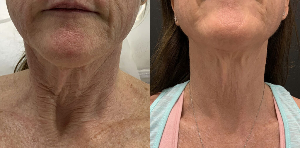 Sofwave Before and After Photo by Refresh Palm Beach Medical Aesthetics in Jupiter Florida