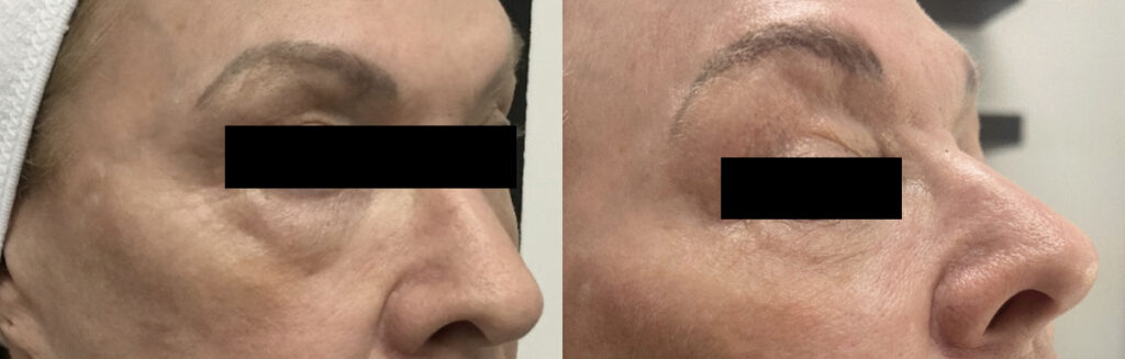 Tear trough Before and After Photo by Refresh Palm Beach Medical Aesthetics in Jupiter Florida