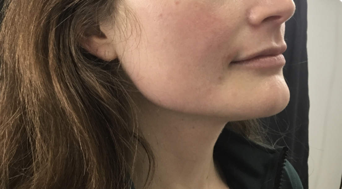 sofwave lower face after