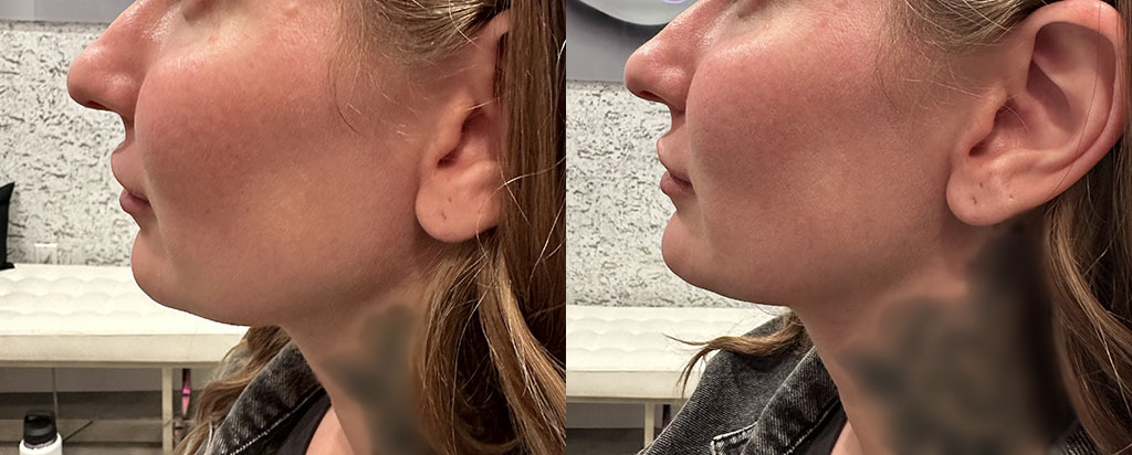 Chin Augmentation Before and After by Refresh Palm Beach Medical Aesthetics in Jupiter, FL