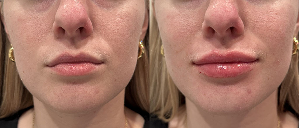 Lip Filler Before and After by Refresh Palm Beach Medical Aesthetics in Jupiter, FL
