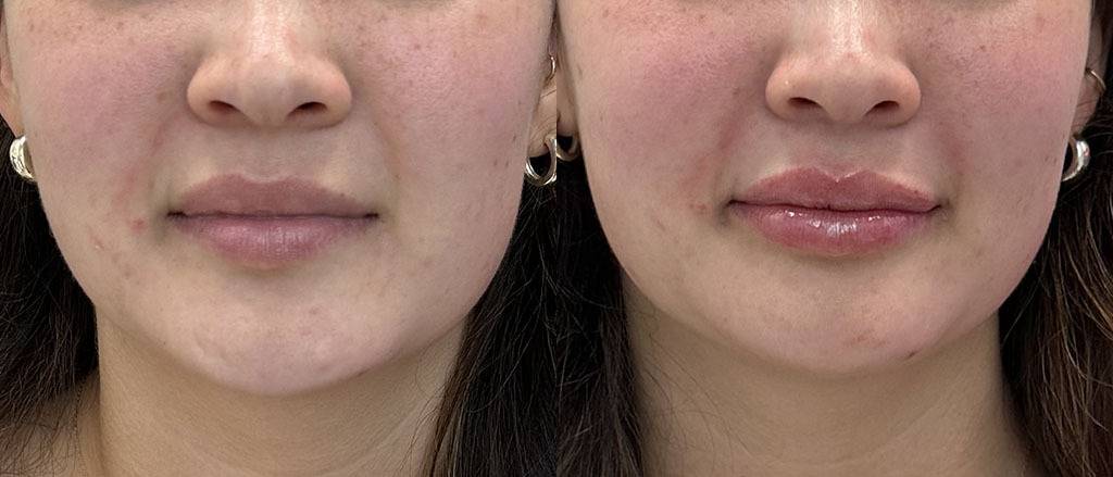 Lip Filler Before and After by Refresh Palm Beach Medical Aesthetics in Jupiter, FL