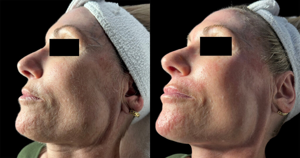 Dermaplanning Before and After Photo by Refresh Palm Beach Medical Aesthetics in Jupiter Florida