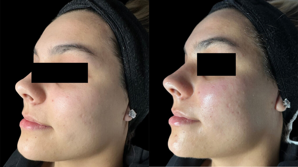 Hydrafacial Before and After Photo by Refresh Palm Beach Medical Aesthetics in Jupiter Florida