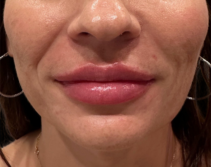Lip filler After Photo by Refresh Palm Beach Medical Aesthetics in Jupiter Florida