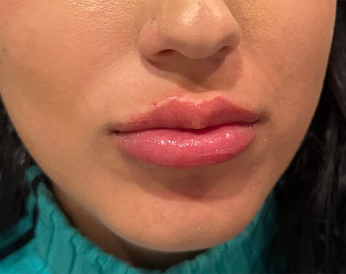 Lip filler After Photo by Refresh Palm Beach Medical Aesthetics in Jupiter Florida
