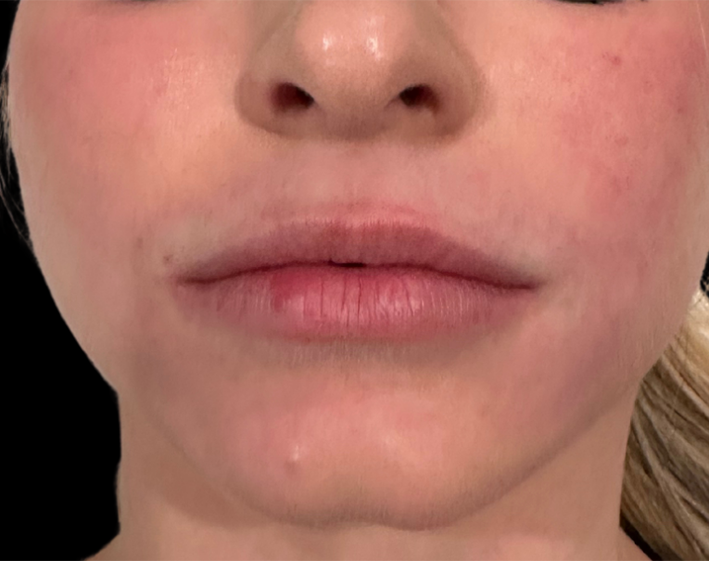 Lip filler Before Photo by Refresh Palm Beach Medical Aesthetics in Jupiter Florida