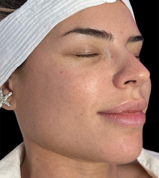 Hydrafacial Before Photo by Refresh Palm Beach Medical Aesthetics in Jupiter Florida