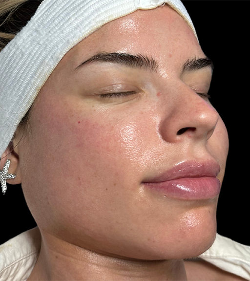 Hydrafacial After Photo by Refresh Palm Beach Medical Aesthetics in Jupiter Florida