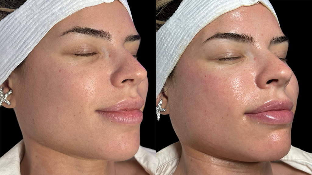 Hydrafacial Before and After by Refresh Palm Beach Medical Aesthetics in Jupiter, FL
