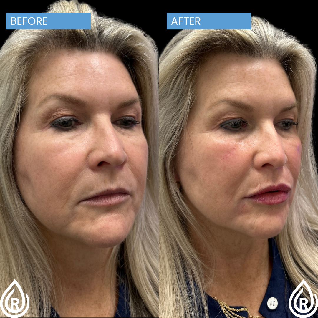 Facial balancing with filler