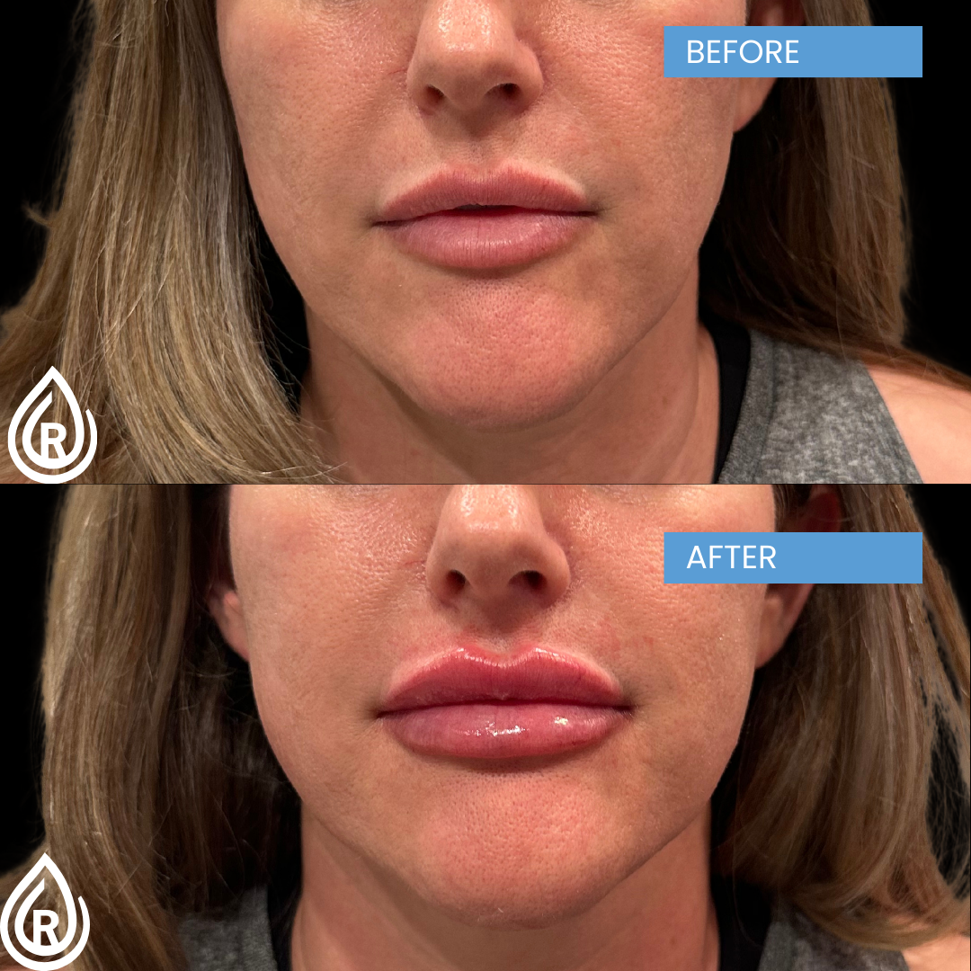 Lip Filler2