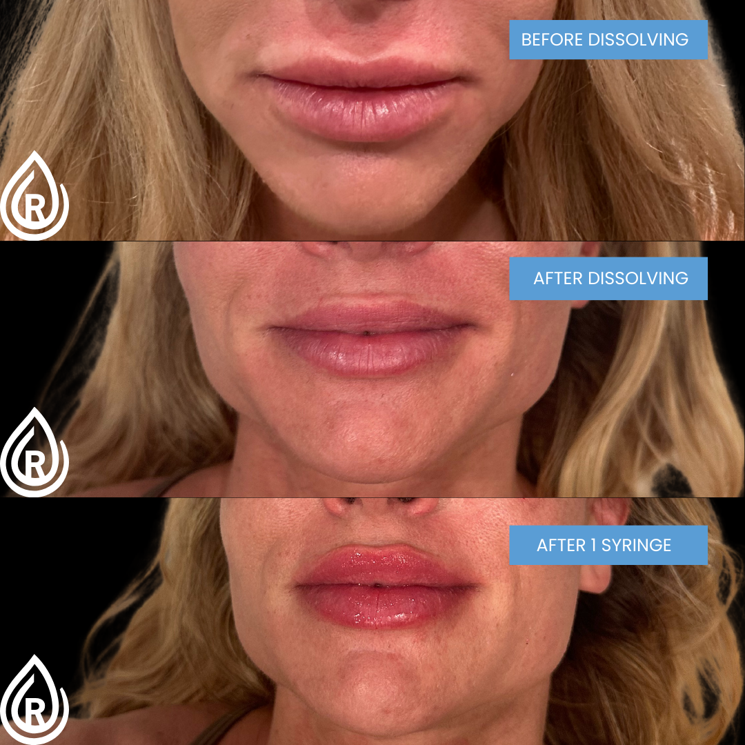 Lip filler dissolving and refill