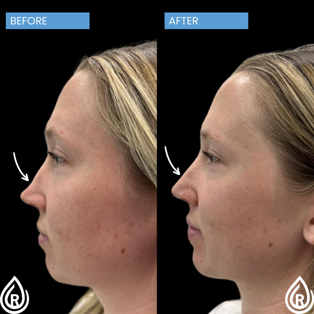 Nose filler2