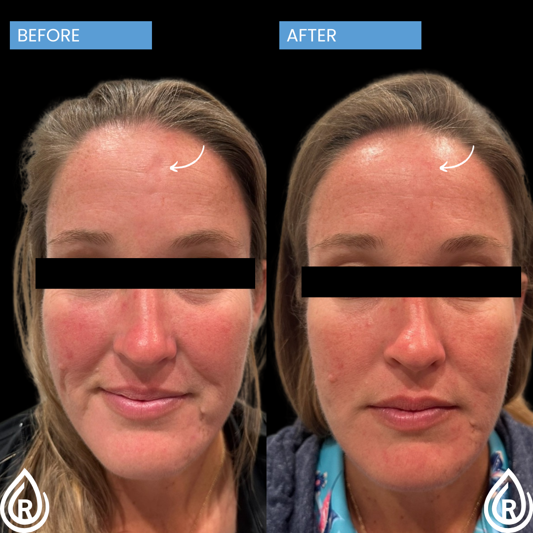 Scar Correction Filler