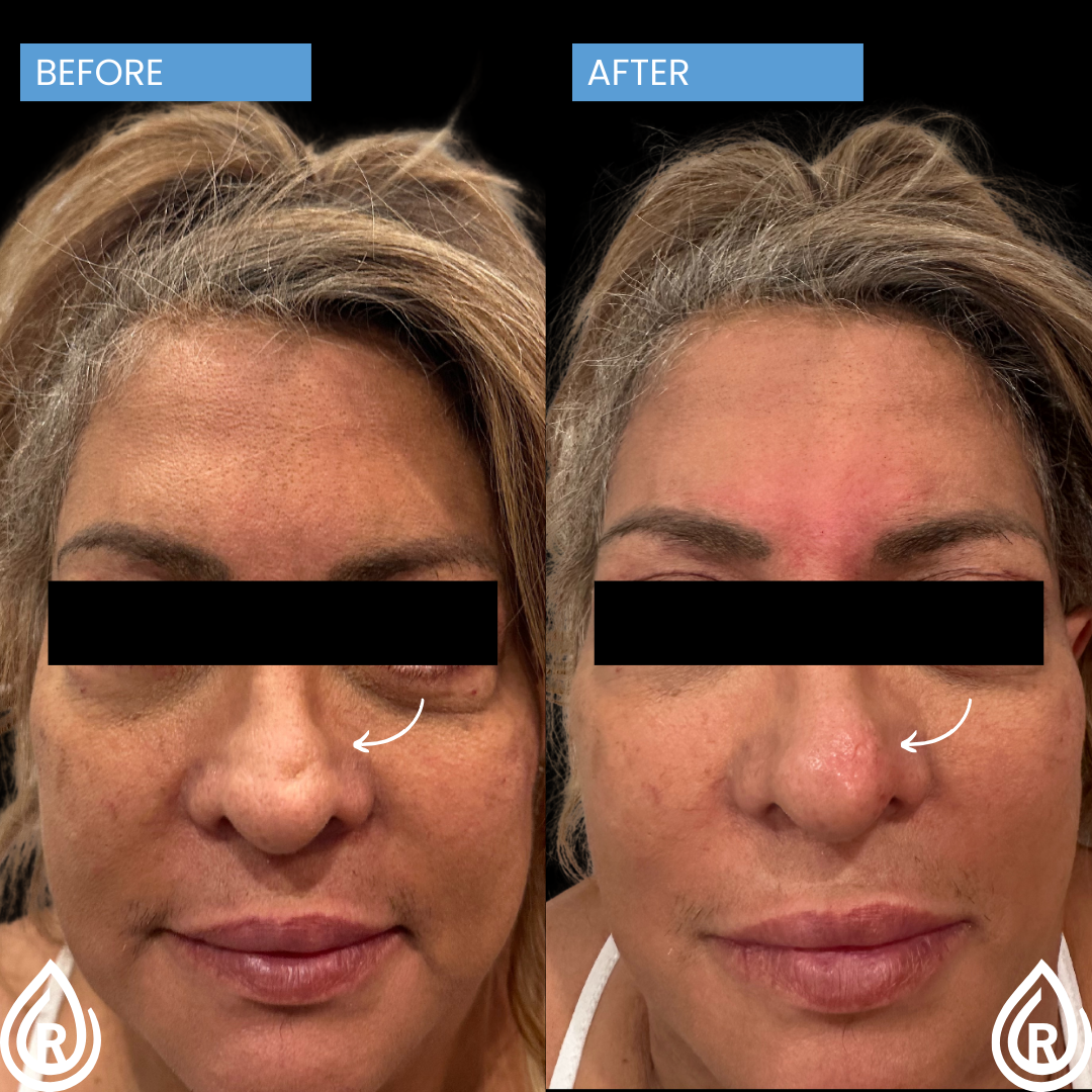 Scar correction with filler