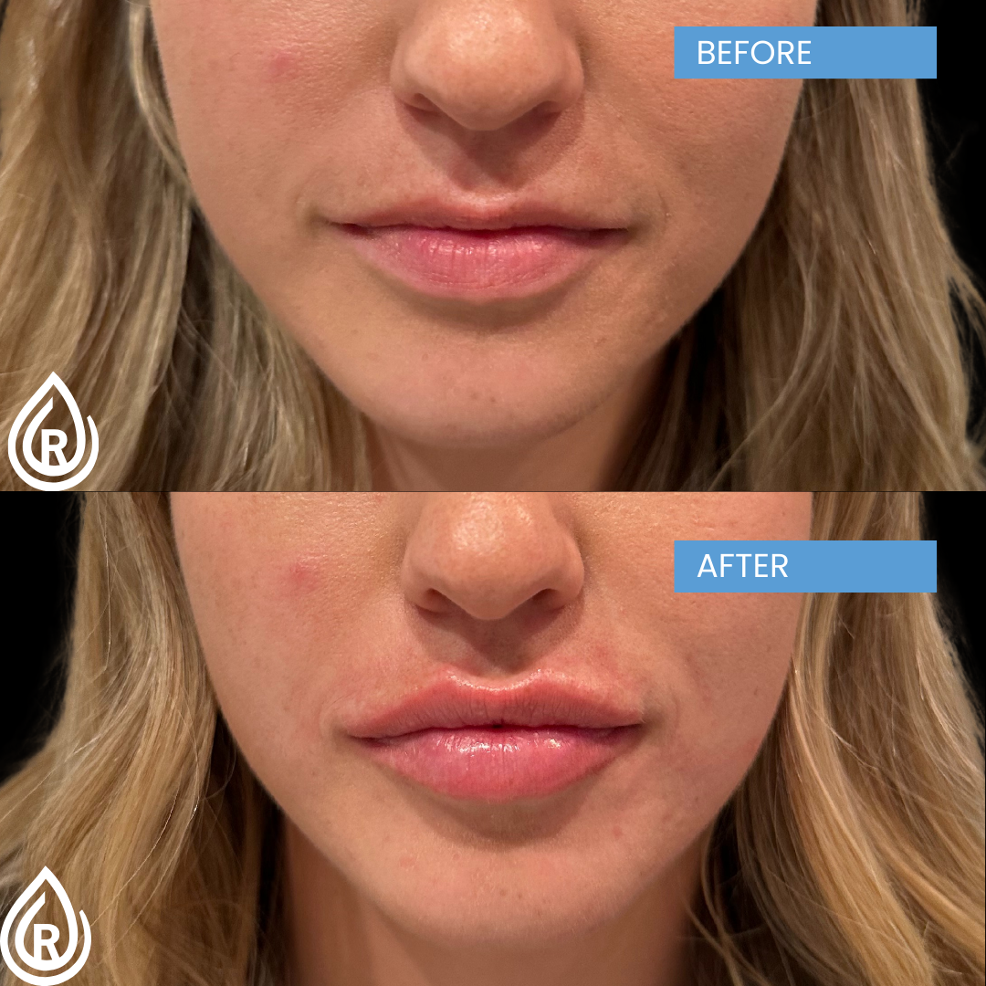 20240719235012 1 lip fillerbefore and after