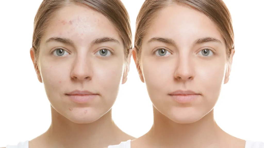 Before After Acne Scarring Stock Photo