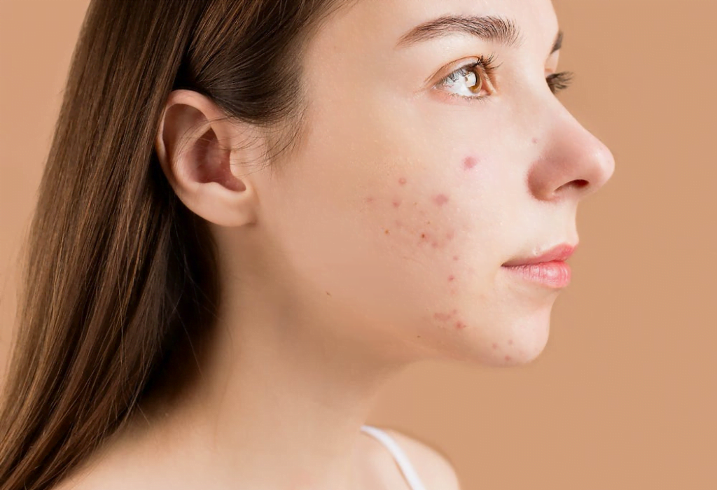 acne scarring