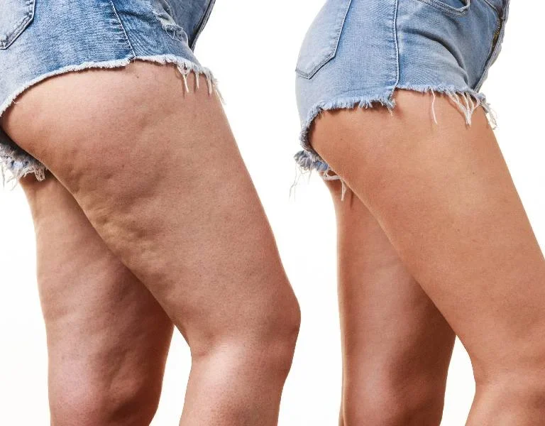 How to Get Rid of Cellulite —And Why EMTONE Is the Best at It