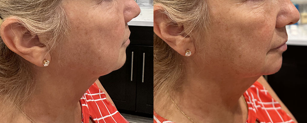 Chin Augmentation Before and After by Refresh Palm Beach Medical Aesthetics in Jupiter FL 1