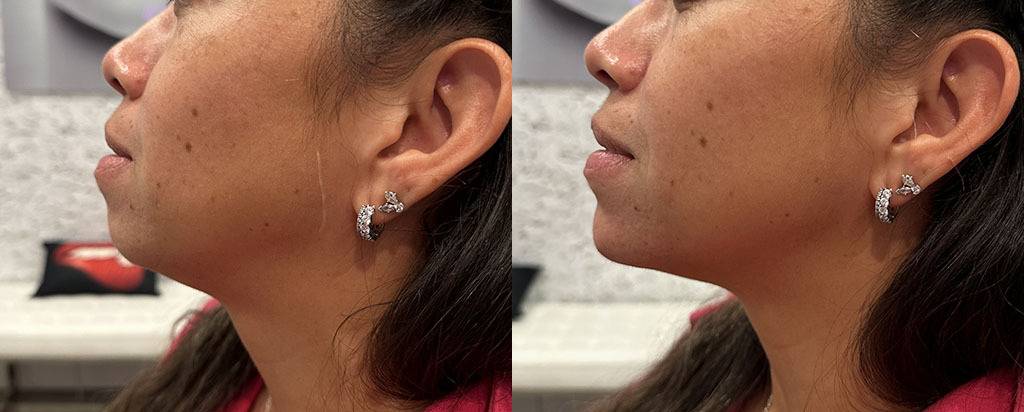 Chin Augmentation Before and After by Refresh Palm Beach Medical Aesthetics in Jupiter FL 2