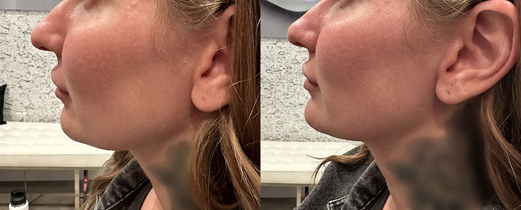 Chin Augmentation Before and After by Refresh Palm Beach Medical Aesthetics in Jupiter FL 3