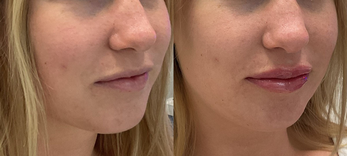 Lip Filler Before and After by Refresh Palm Beach Medical Aesthetics 2