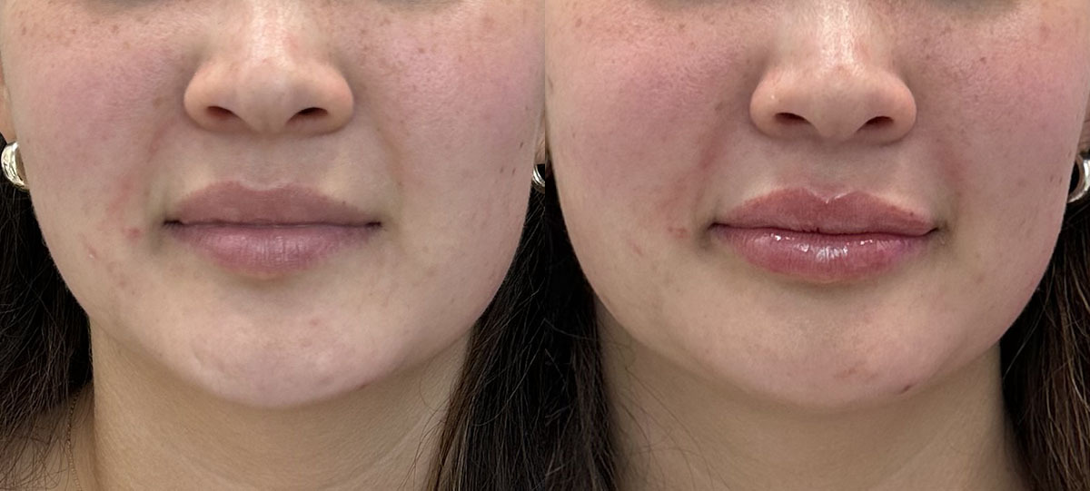 Lip Filler Before and After by Refresh Palm Beach Medical Aesthetics 3