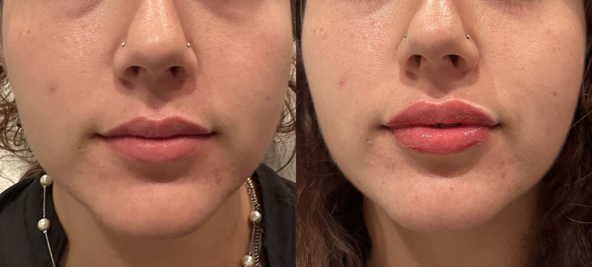 Lip Filler Before and After by Refresh Palm Beach Medical Aesthetics 4