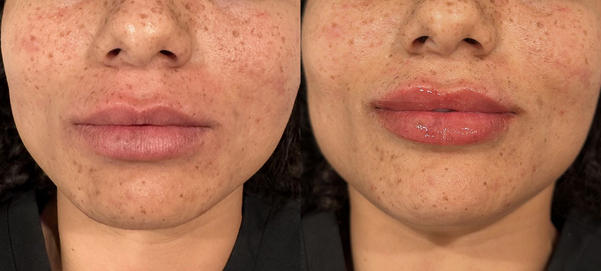 Lip Filler Before and After by Refresh Palm Beach Medical Aesthetics 5 1