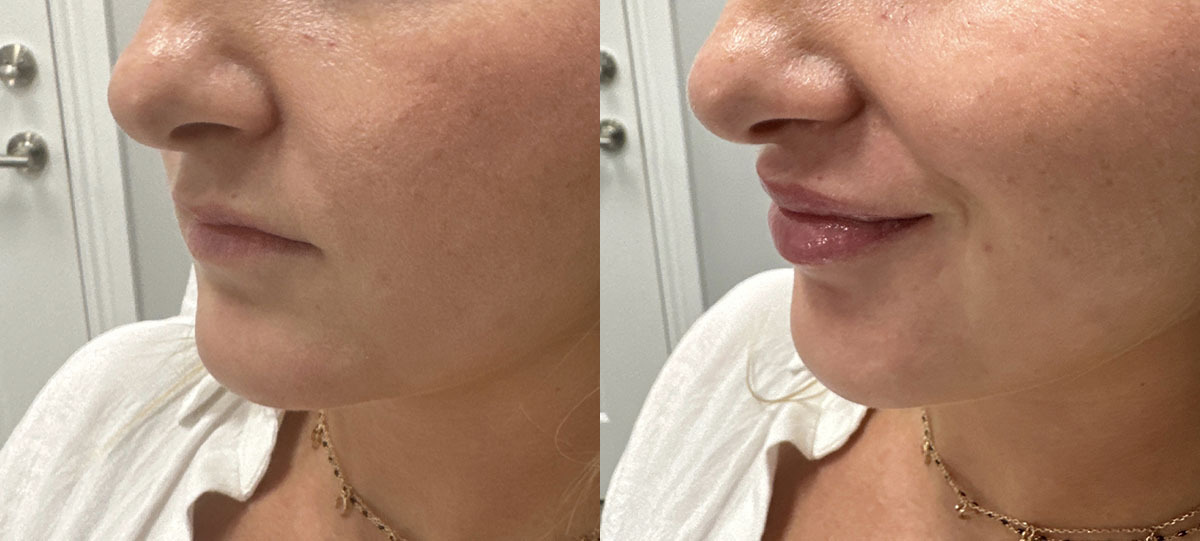 Lip filler before after photo2