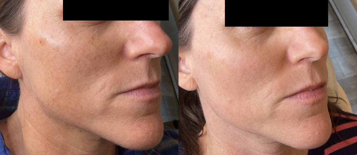 Photofacial Before and After