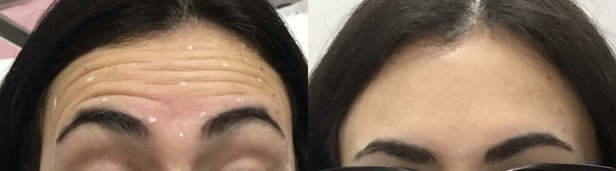 botox before after photo4