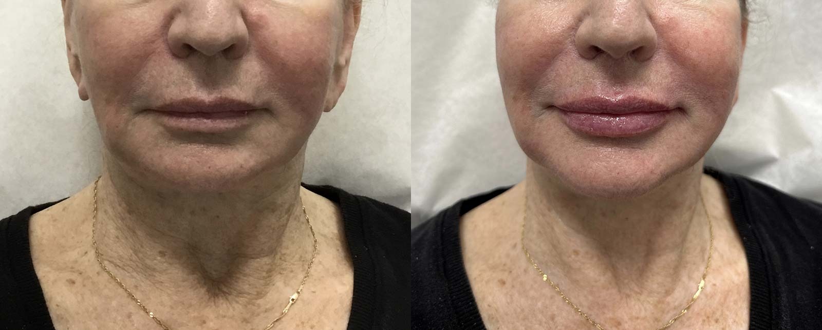 chin augmentation before after