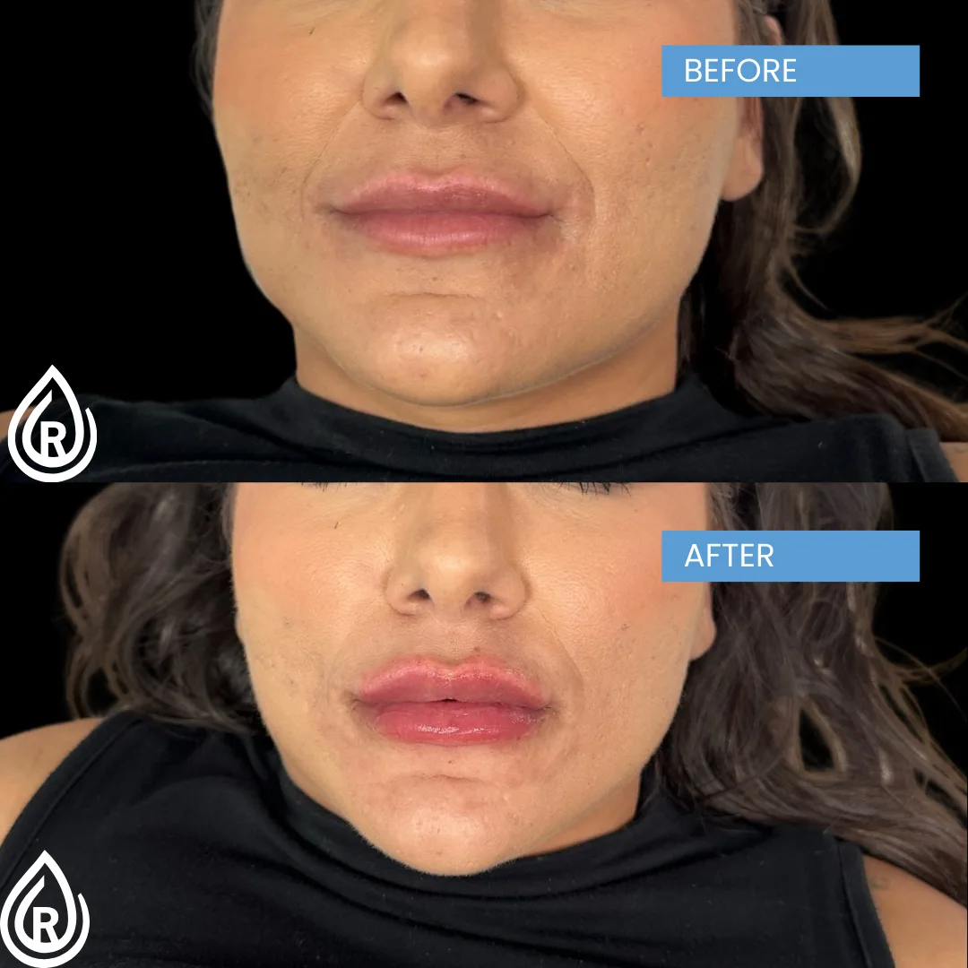 Lip Filler 20